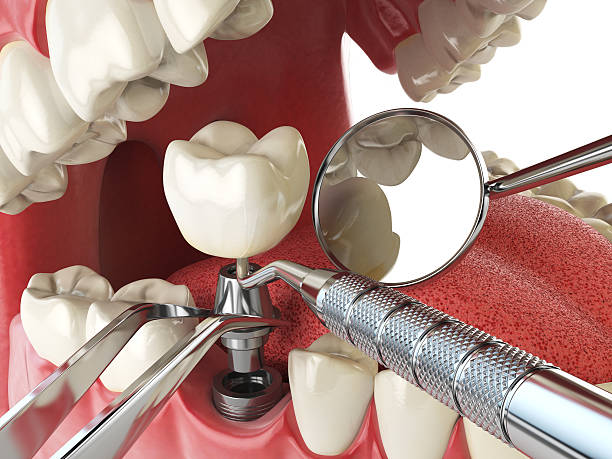 Best Emergency Dental Care for Abscessed Tooth in Richland Hills, TX